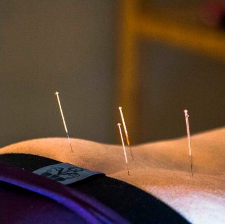 Mónica Valls tratamiento de acupuntura
